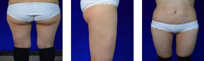 广州韩妃整形吸脂瘦大腿案例