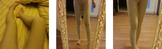 广州韩妃整形吸脂瘦大腿案例