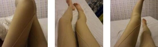 广州韩妃整形吸脂瘦大腿案例