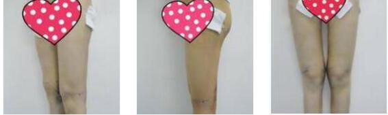 福州美贝尔整形赵栋材做吸脂瘦大腿案例