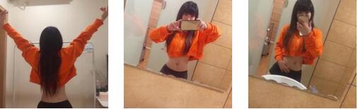 重庆好美整形罗海军医生吸脂瘦腹部案例