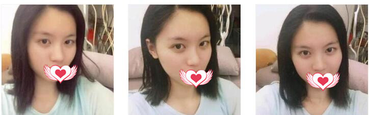 福州爱美尔整形张胜利做隆鼻案例