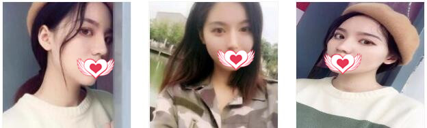 福州爱美尔整形张胜利做隆鼻案例