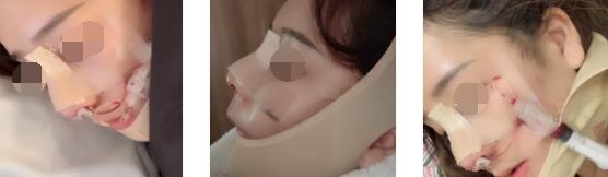 重庆珂琳雅整形王陈自体肋软骨+膨体隆鼻案例