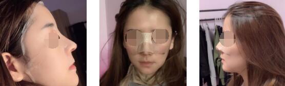 重庆珂琳雅整形王陈自体肋软骨+膨体隆鼻案例