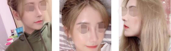 重庆珂琳雅整形王陈自体肋软骨+膨体隆鼻案例