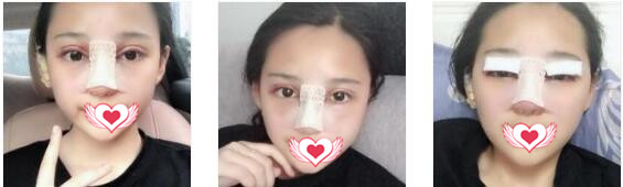 杭州美莱整形做鼻部综合术案例
