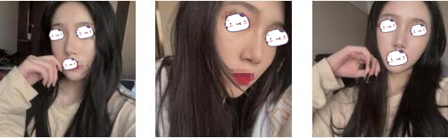 重庆五洲女子整形魏恒医生鼻综合案例
