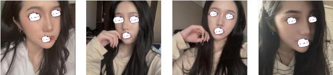重庆五洲女子整形魏恒医生鼻综合案例