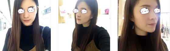 长沙美莱整形玻尿酸隆鼻案例