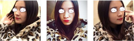 长沙美莱整形玻尿酸隆鼻案例