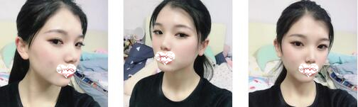 西安艺星整形鼻综合案例