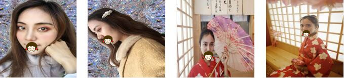 昆明市延安医院杰西艾美容医院鼻综合案例