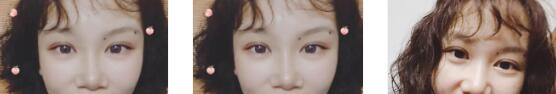 长沙美莱整形切开双眼皮案例
