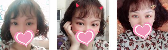 长沙美莱整形切开双眼皮案例