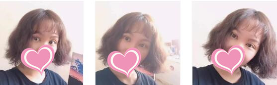 长沙美莱整形切开双眼皮案例