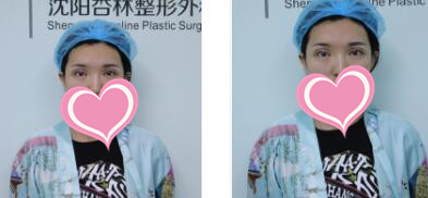 沈阳杏林整形切开双眼皮案例