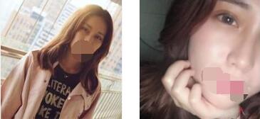 昆明艺星整形全切双眼皮手术案例