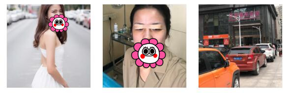 武汉华美整形眼综合案例