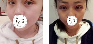 贵阳美贝尔整形双眼皮案例