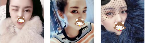 长春珍妮整形双眼皮修复案例