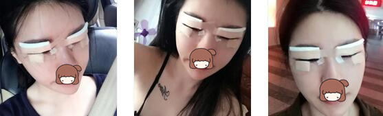 长沙雅美整形双眼皮案例