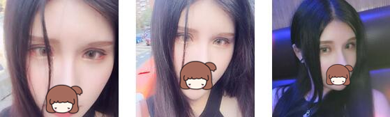 长沙雅美整形双眼皮案例