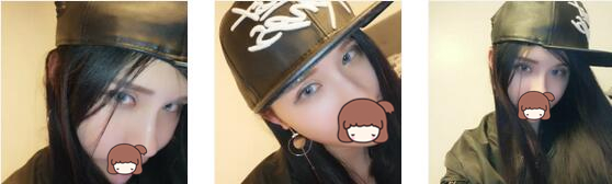长沙雅美整形双眼皮案例