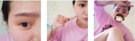 成都米兰柏羽整形双眼皮案例