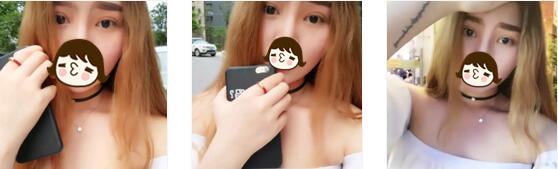成都米兰柏羽整形双眼皮案例