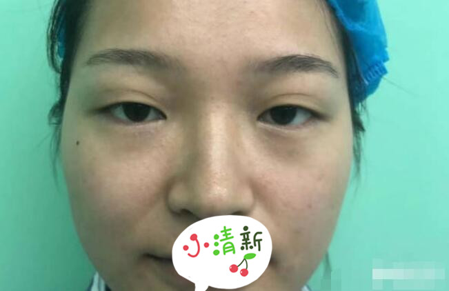 河北医科大学医院张卓男医生双眼皮修复案例