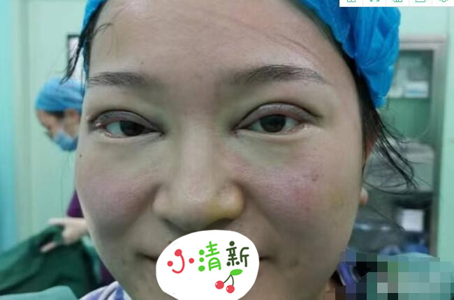河北医科大学医院张卓男医生双眼皮修复案例