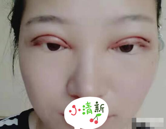河北医科大学医院张卓男医生双眼皮修复案例