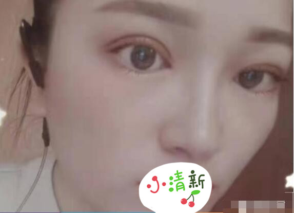 河北医科大学医院张卓男医生双眼皮修复案例