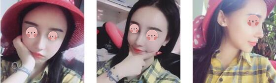 遂宁伊莎贝拉整形罗华医生鼻综合案例