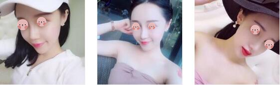 遂宁伊莎贝拉整形罗华医生鼻综合案例