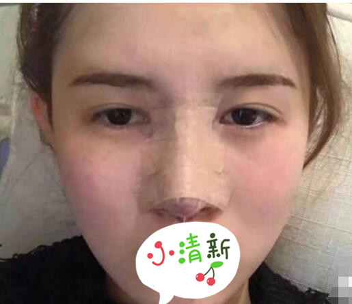 北大深圳医院整形崔永言医生耳软骨隆鼻案例