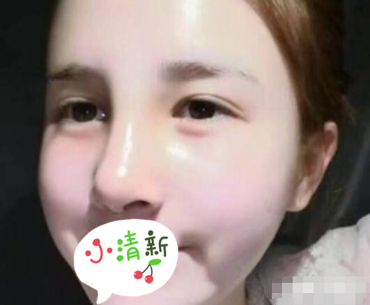 北大深圳医院整形崔永言医生耳软骨隆鼻案例