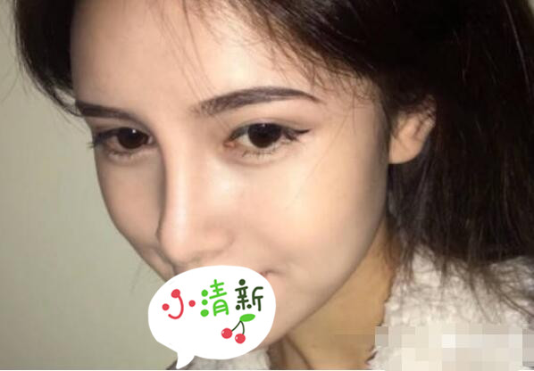 北大深圳医院整形崔永言医生耳软骨隆鼻案例