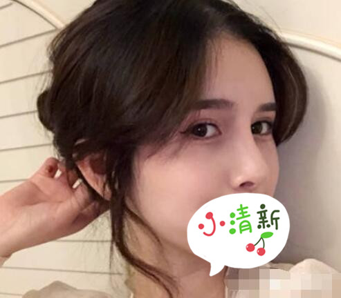 北大深圳医院整形崔永言医生耳软骨隆鼻案例