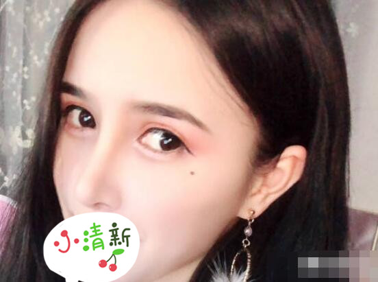 北大深圳医院整形崔永言医生耳软骨隆鼻案例