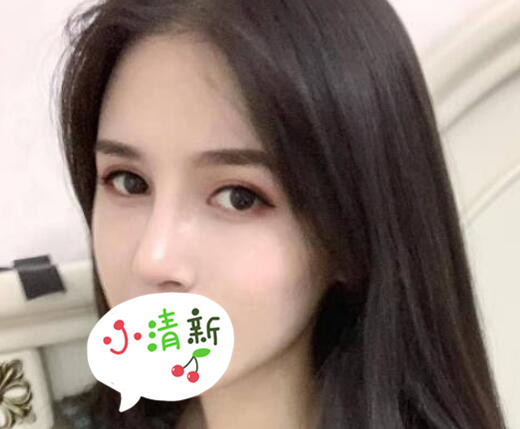 北大深圳医院整形崔永言医生耳软骨隆鼻案例