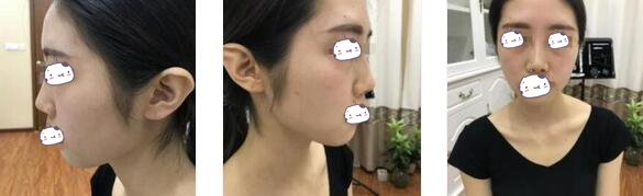 重庆军美整形章小平医生膨体垫下巴案例