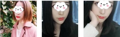 武汉希思特整形肉毒素瘦脸案例