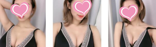 沈阳杏林整形假体隆胸案例