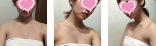 沈阳杏林整形假体隆胸案例