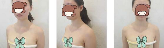南京美贝尔整形假体隆胸案例