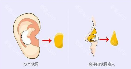 耳软骨隆鼻示意图