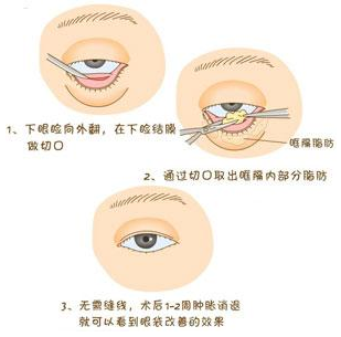 内切去眼袋手术流程图