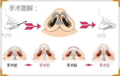 鼻翼缩小手术过程示意图